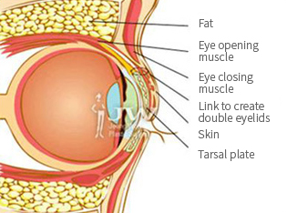 Double-Eyelid-Surgery2