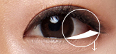 Lateral-canthoplasty-3