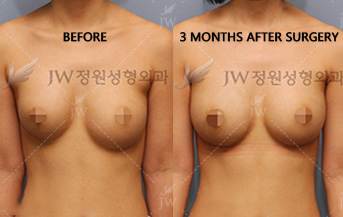breast-revision-surgery-jw-plastic-surgery-clinic-4a