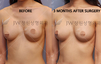 breast-revision-surgery-jw-plastic-surgery-clinic-4b