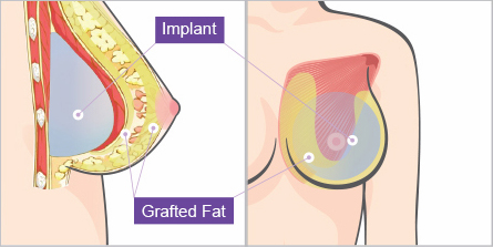 breast-stem-cell-graft-augmentation-jw-1