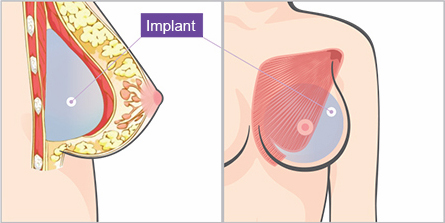 breast-stem-cell-graft-augmentation-jw-2