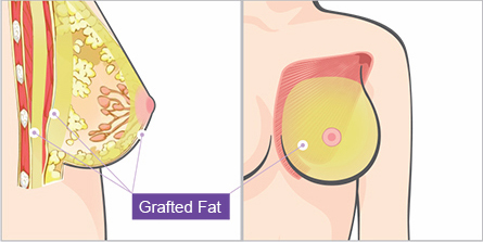 breast-stem-cell-graft-augmentation-jw-3-1