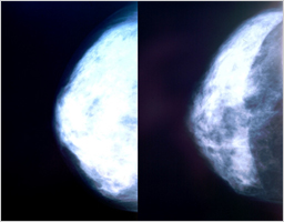 breast4_img1