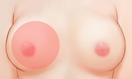 breast4_img1b