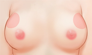 breast4_img1g