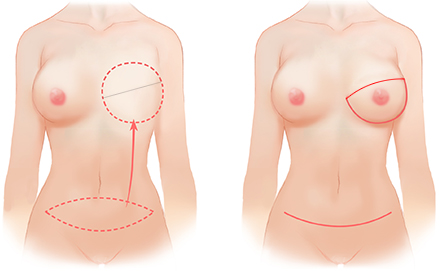 breast9_img1