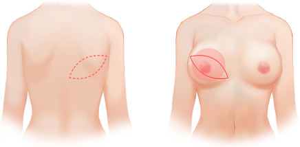 breast9_img2