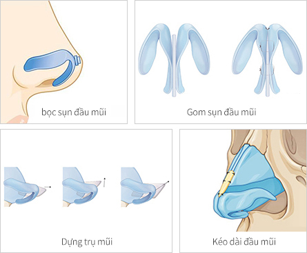 chinh-hinh-mui-ngan5