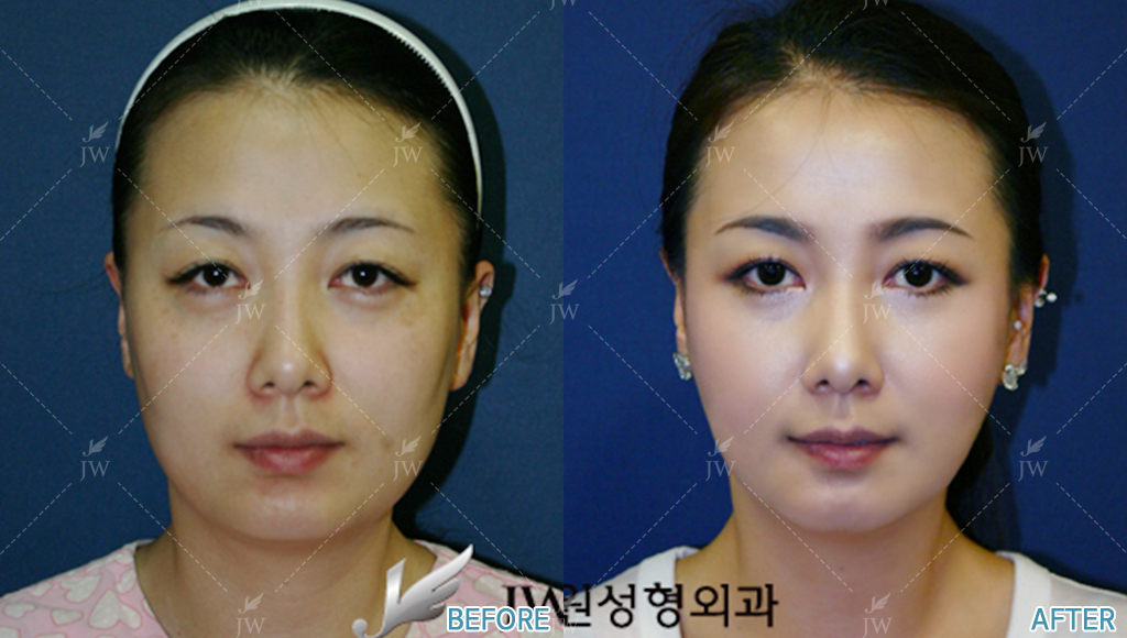 Facial Bone Contouring Cheekbone Reduction, Square Jaw Reduction