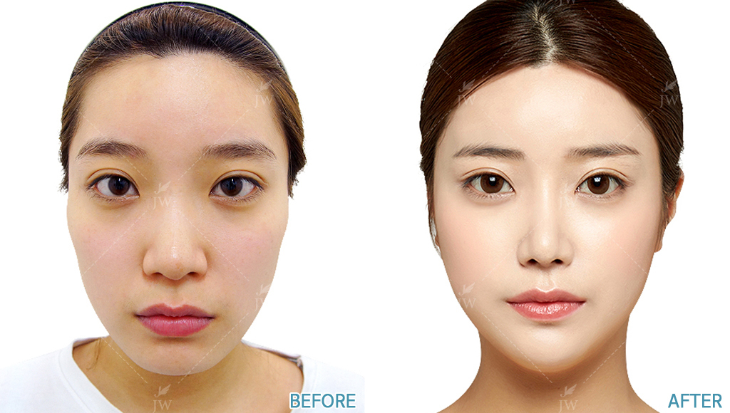 Facial Bone Contouring Cheekbone Reduction, Square Jaw Reduction