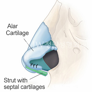 long-nose-correction-surgery-2