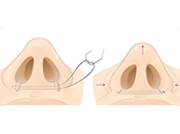 nose9_img3a