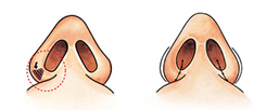 nose_img4_3