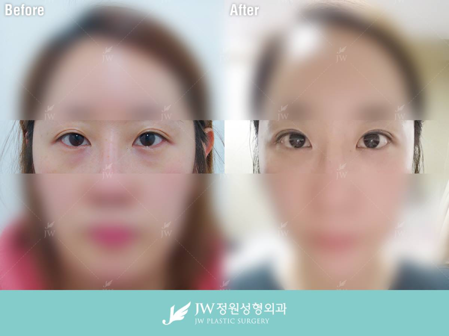 Non-incision undereye surgery in Seoul, Korea